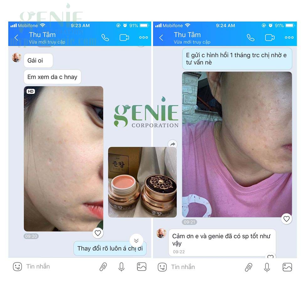 kem trị sẹo rỗ genie | kem trị sẹo rỗ hàn quốc